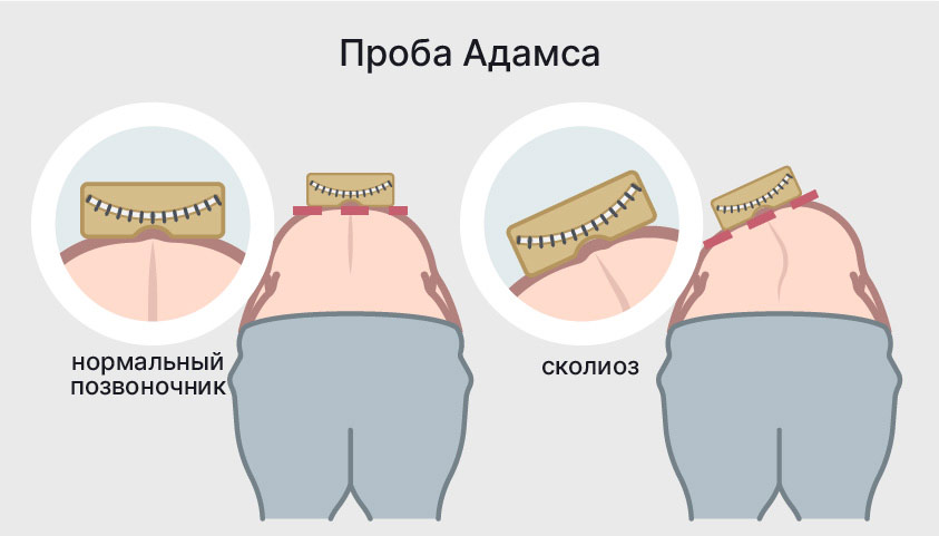 Как распознать сколиоз у ребенка самостоятельно?